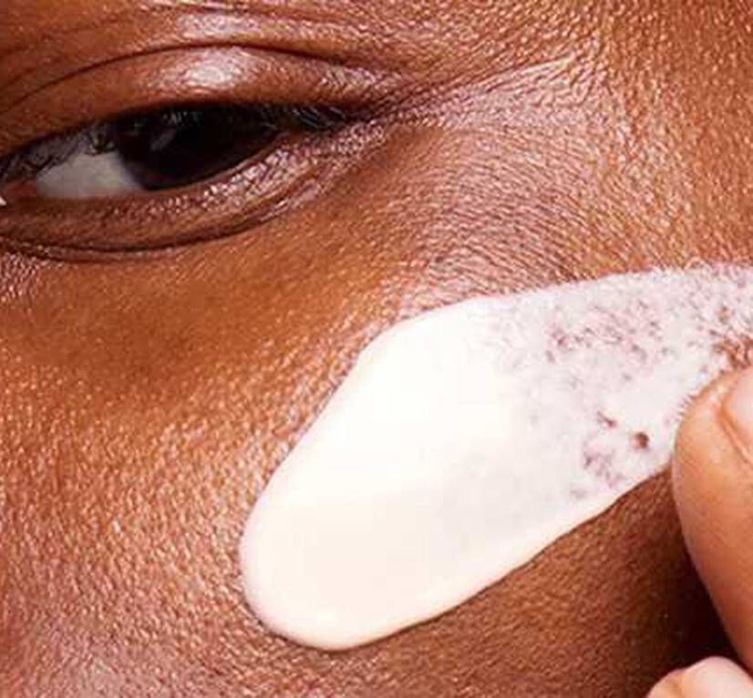 hyperpigmentation