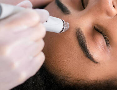 Adult Acne + Scarring