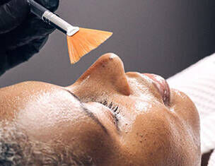 chemical peels for dark spots