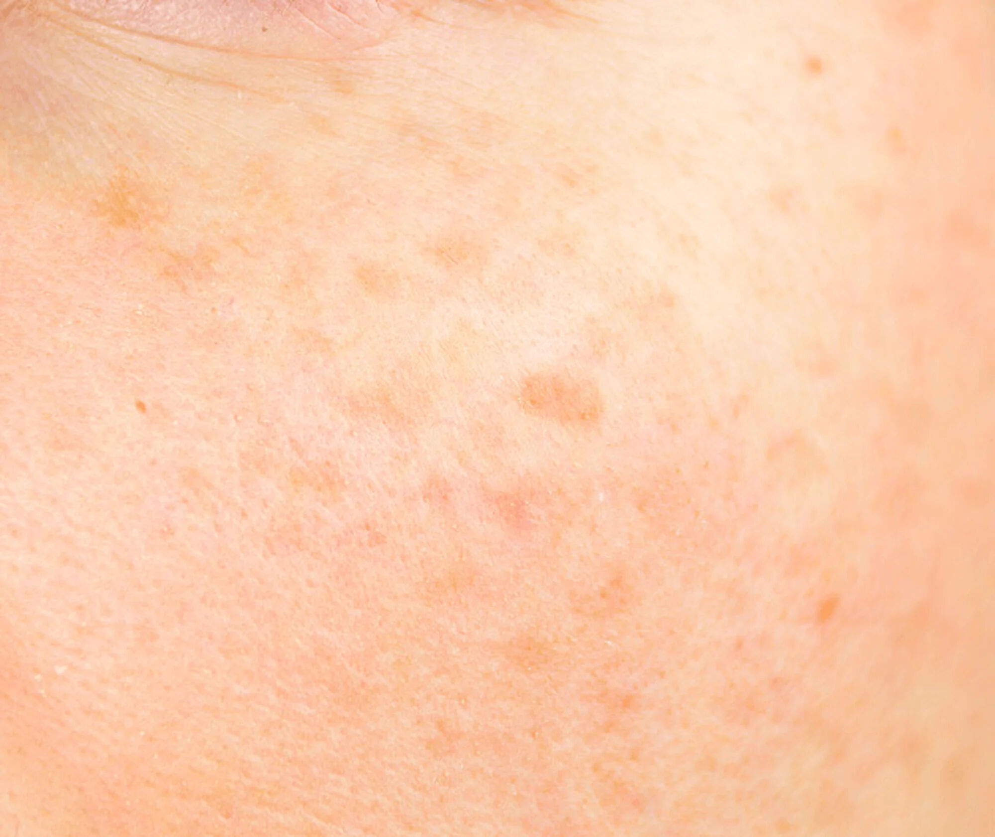 What is Kojic Acid? 5 Kojic Acid Benefits for Skin
