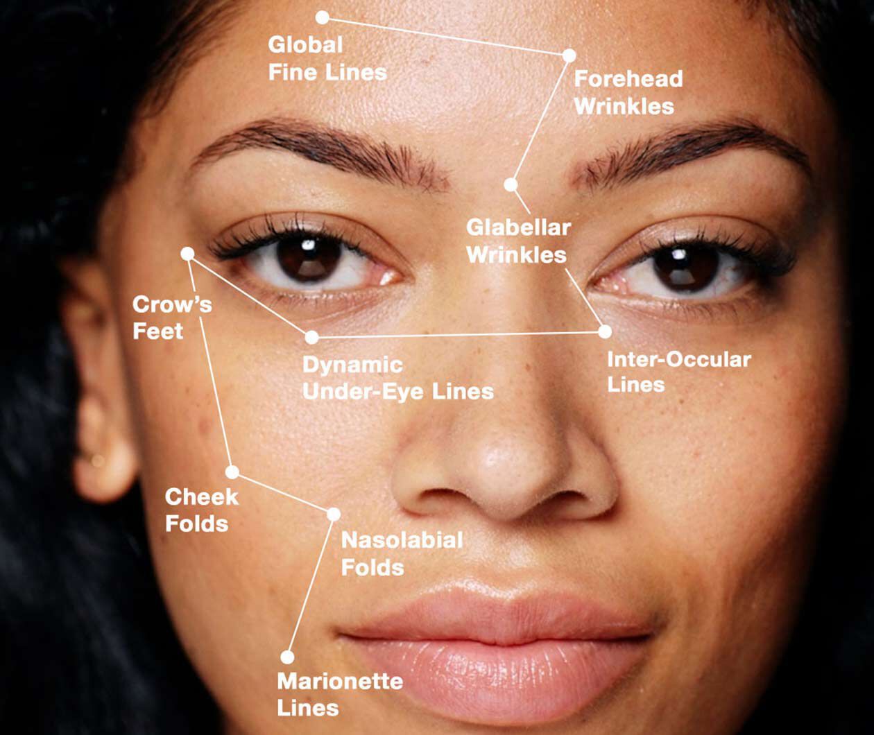  Formation of expression wrinkles