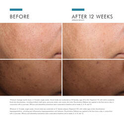 Before and after comparison showing visible improvement in skin tone and reduced dark spots after 12 weeks of use