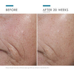 Before and after 20 weeks using SkinCeuticals C E Ferulic vitamin C serum for dark spots and uneven skin tone improvement	