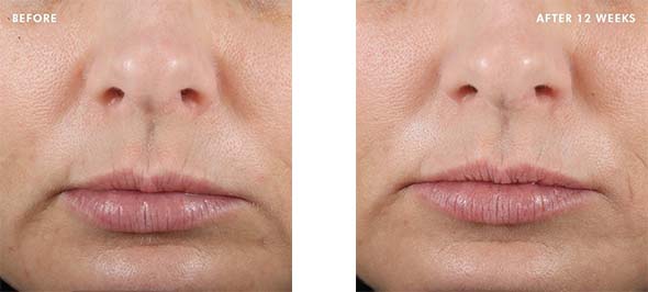 Before and After CE Ferulic
