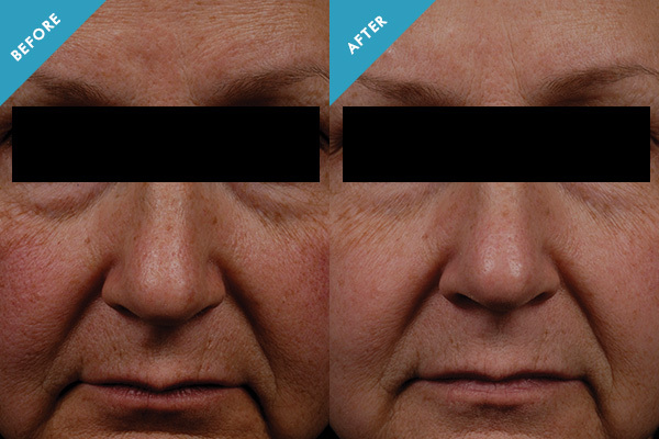 Before and After CE Ferulic