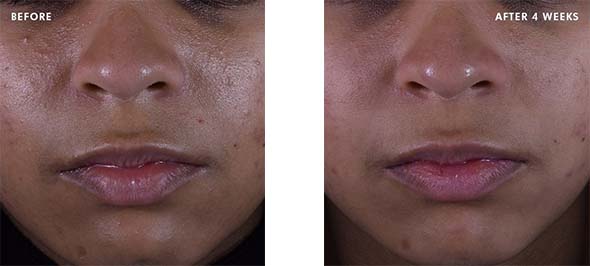 Before and After Silymarin
