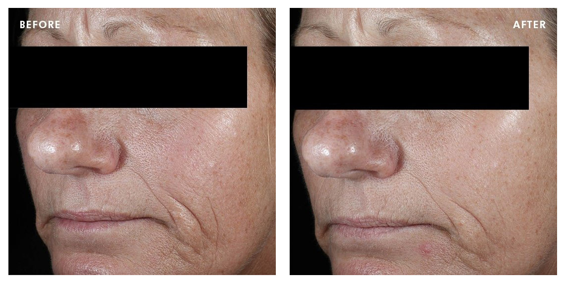 Before and After CE Ferulic