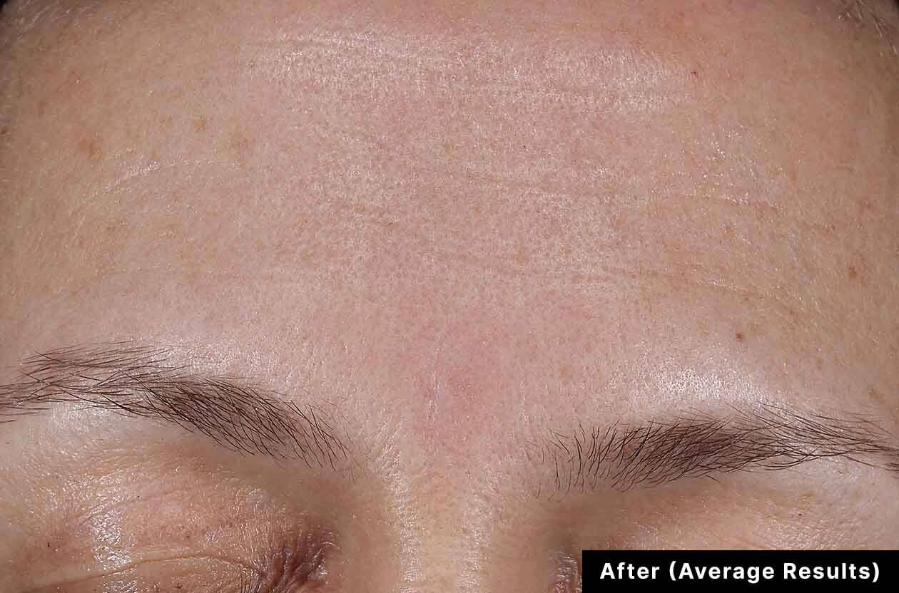 A person's skin before using SkinCeuticals' Cell Cycle Catalyst