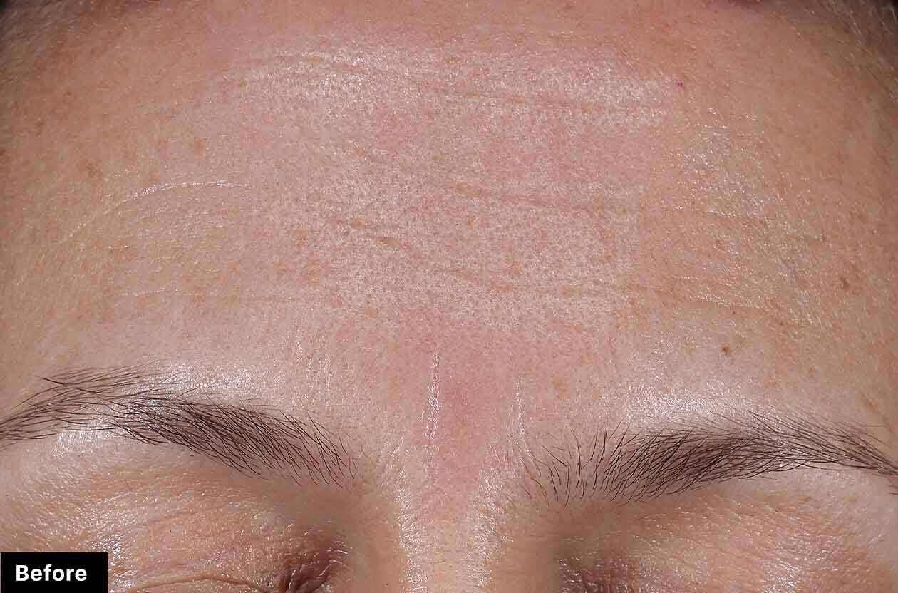 A person's skin before using SkinCeuticals' Cell Cycle Catalyst